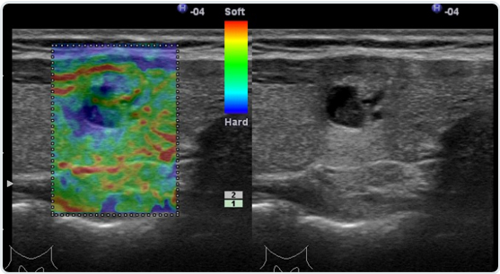 Узи щитовидной железы с эластографией. Эластография щитовидной железы это УЗИ?. Эластография сдвиговой волны щитовидной железы. Соноэластография ультразвуковая эластография. Эластография узлов щитовидной железы.